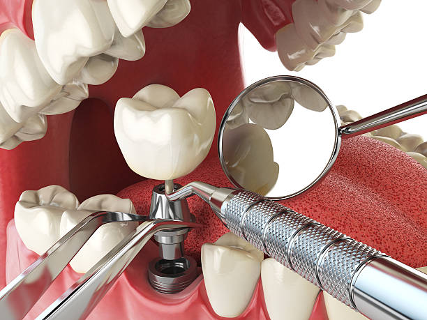 Best Emergency Dental Care for Broken or Chipped Teeth in Griggsvle, IL